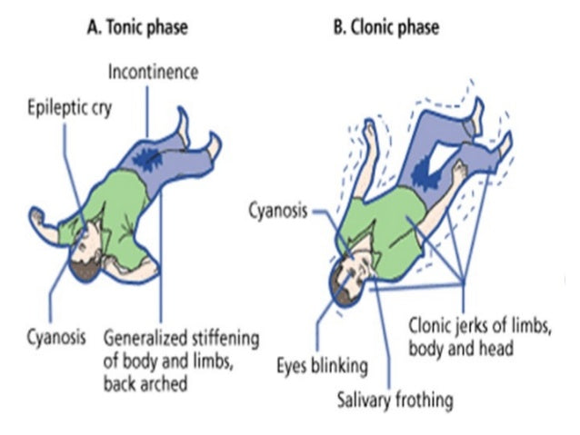 Medical Corner : All about Seizures